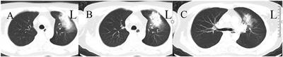 Extracorporeal Membrane Oxygenation in Severe Acute Respiratory Distress Syndrome Caused by Chlamydia psittaci: A Case Report and Review of the Literature